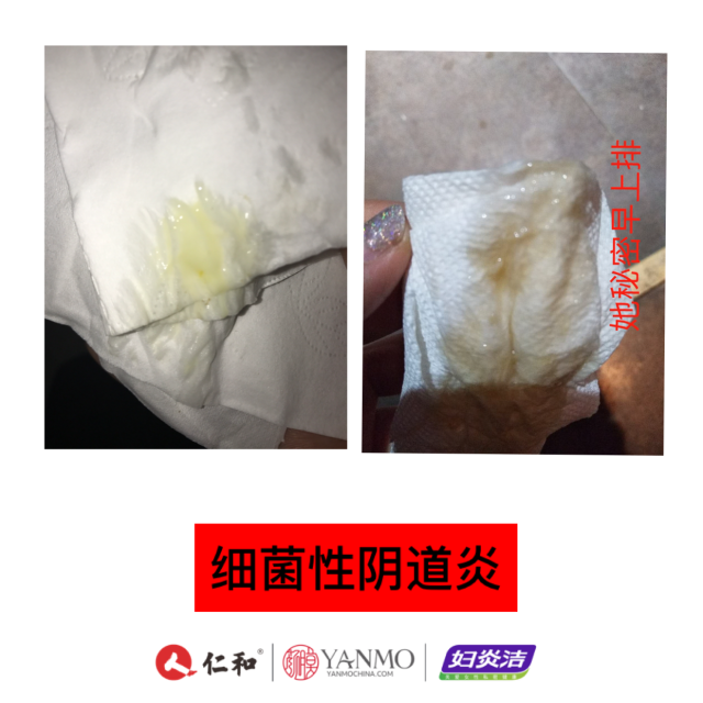 用康复凝胶后排出图片图片