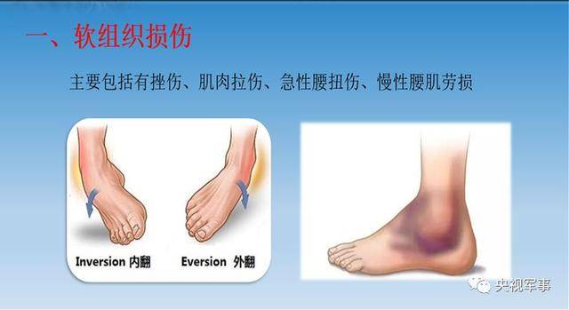 软组织损伤症状