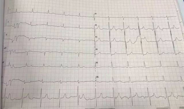 術後心電圖:廣泛st異常,可能心肌缺血.