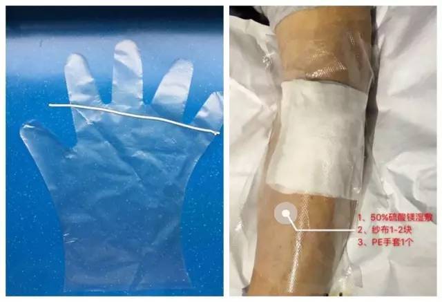 一敷一贴,造影剂外渗轻松搞定!