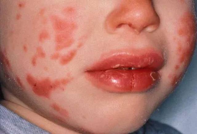 宝宝红色斑丘疹的图片图片
