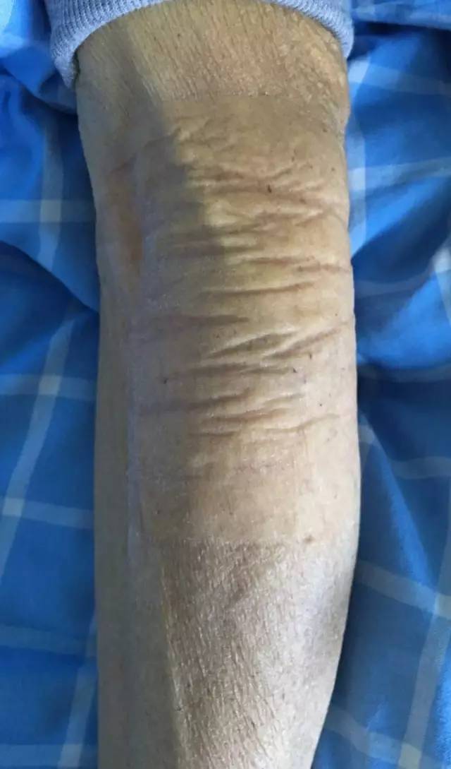 一敷一贴,造影剂外渗轻松搞定!