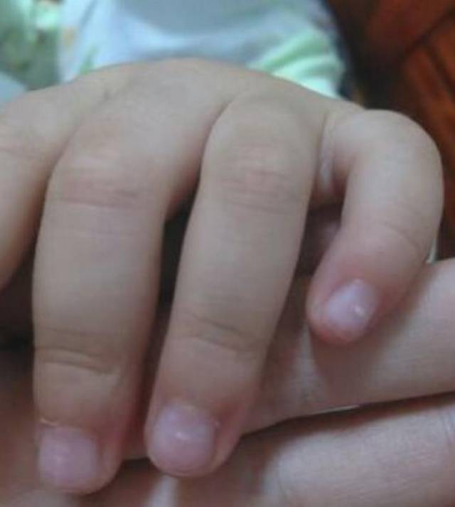 宝宝营养不良指甲图片图片