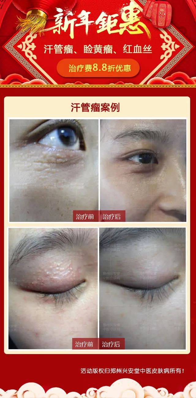 治疗原理:汗管瘤是由于汗腺堵塞造成的,加拿大完美肌肤仪,它是一种