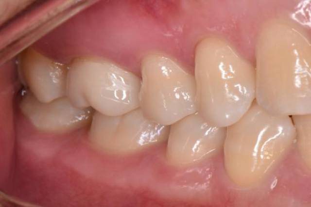 修复体粘接后咬牙合面观