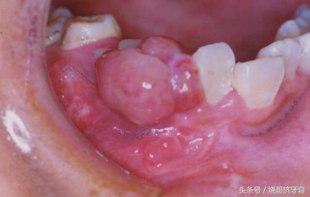 牙龈血管瘤图片