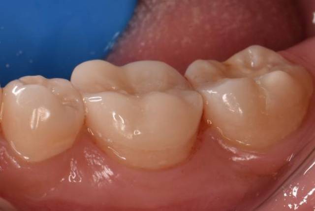 修复体粘接后咬牙合面观