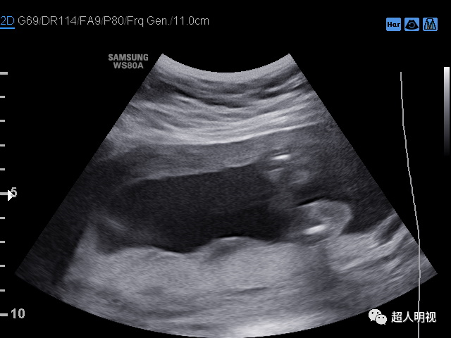 再谈容易漏诊的胎儿膀胱外翻