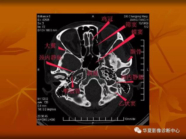 最全的颅骨ct解剖及外伤骨折的诊断