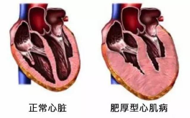 頭暈,呼吸困難,胸痛,我是肥厚型心肌病嗎?