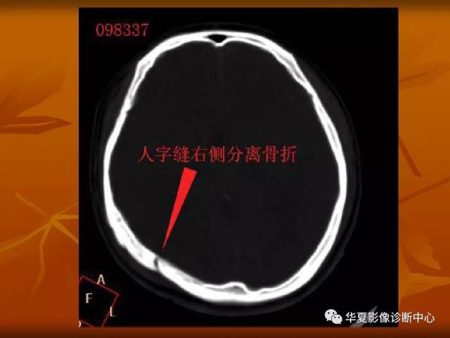 最全的颅骨ct解剖及外伤骨折的诊断