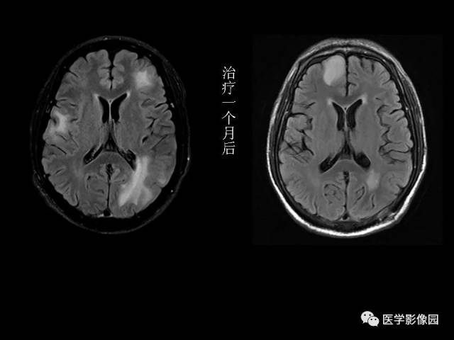 腦脫髓鞘疾病的影像診斷丨影像天地