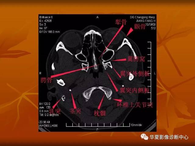 头颅骨ct图片