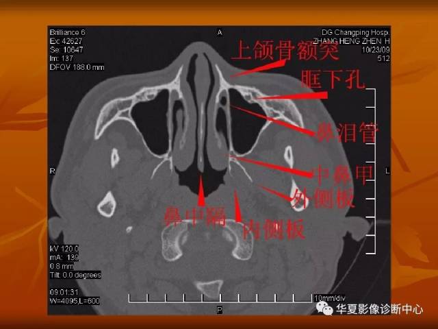 最全的颅骨ct解剖及外伤骨折的诊断