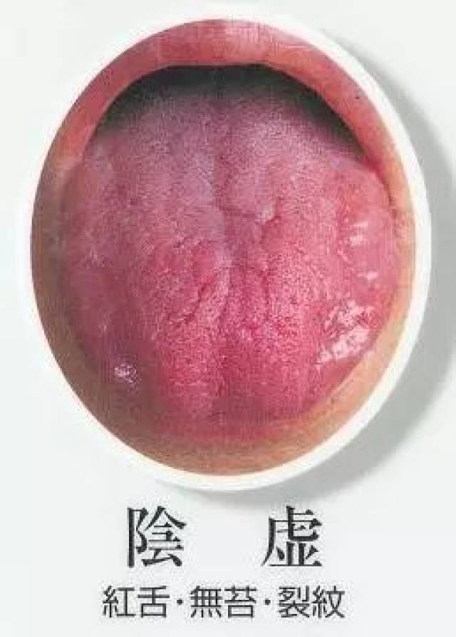 舌头变成这样说明你肾虚了