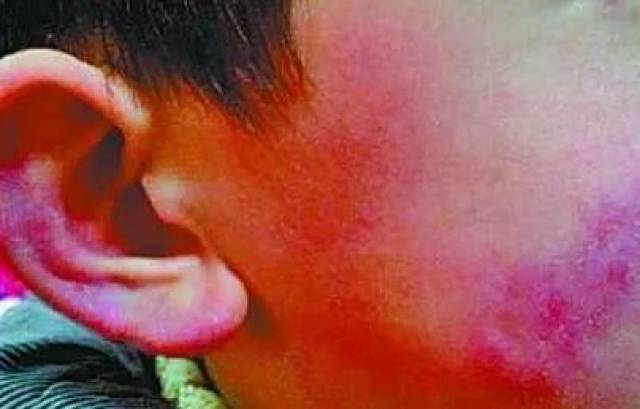 耳朵长了冻疮之后
