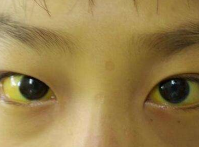 肝痛,极度乏力后,忽然出现眼睛和皮肤发黄,则表明患了急性黄疸型肝炎