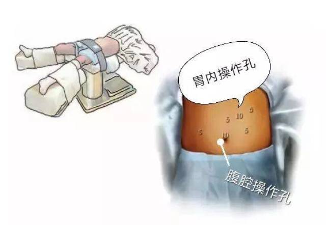 腹腔镜trocar位置图片