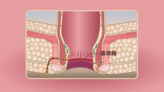 肛瘘手术挂线法示意图图片