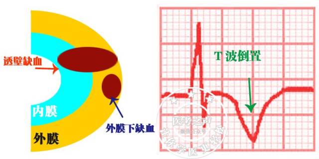 千呼萬喚,心電圖下篇來啦……心梗,心肌缺血心電圖這麼看!