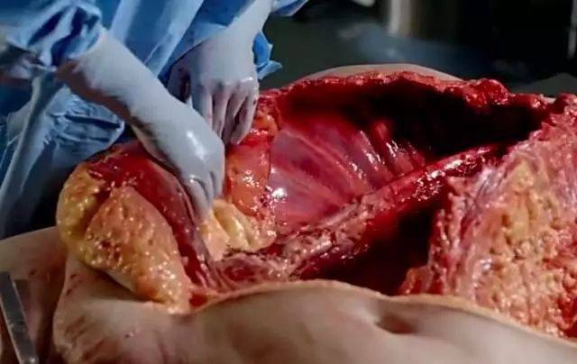 解剖怀孕肚皮图片