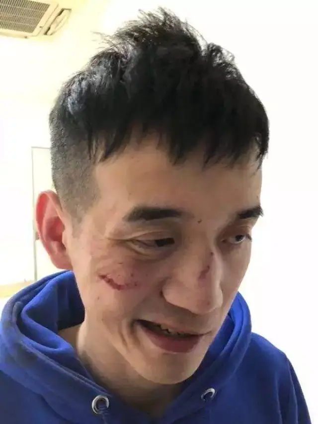lol年度最佳视频获奖作者蛋蛋被一群人围殴 鼻骨骨折多处挫伤