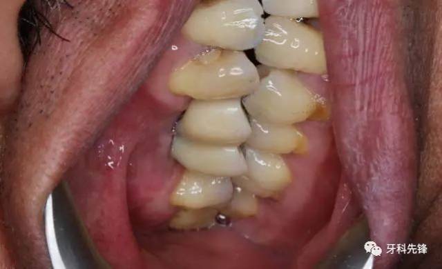 【病例】两颗种植牙种歪的病例补救