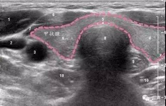 甲状腺测量示意图图片