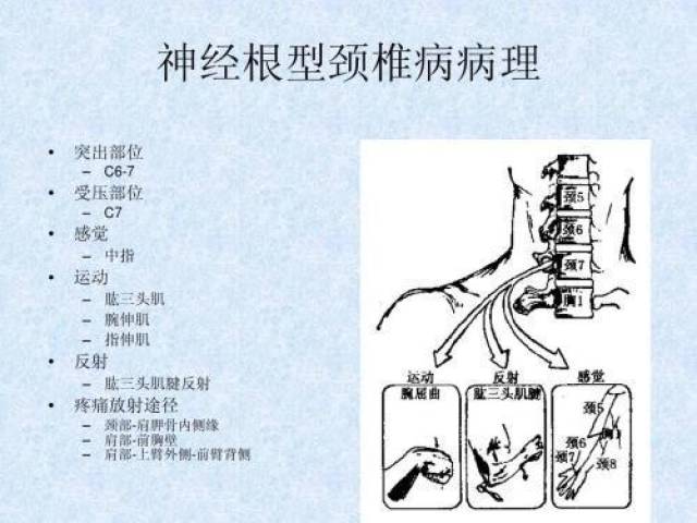 神經根型頸椎病約佔頸椎病的60%,應選擇保守治療還是手術治療?