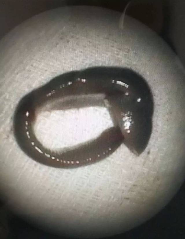 梅州一男子鼻子里"养"了只吸血虫子,竟然和洗脸有关!