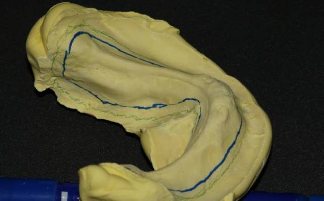 模与摸:活动义齿之取模