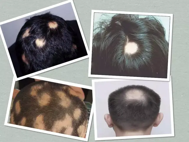 斑秃在医学上解释为:一种非瘢痕性脱发, 常发生在身体有毛发的部位
