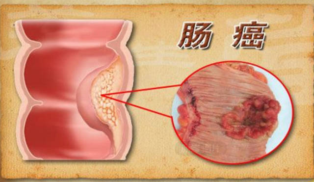 结肠癌早期的5大症状图片