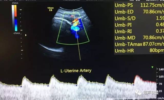 超聲監測子宮動脈