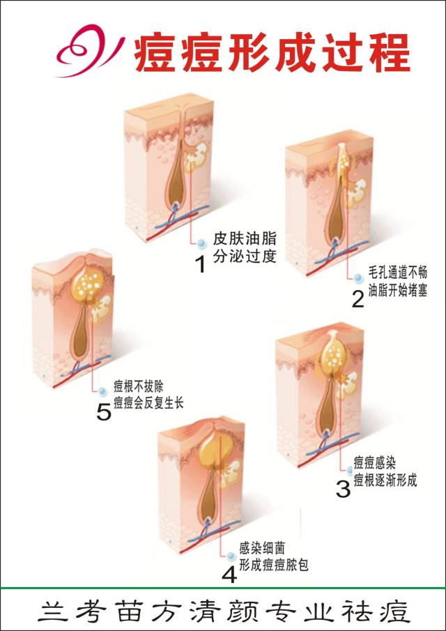 粉刺發病原因:粉刺是皮脂腺分泌油脂過多堵塞毛孔發炎所致.