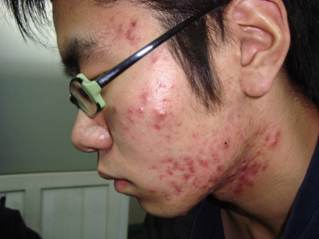 【痘痘的发病原理】:皮脂腺分泌过多堵塞毛孔发炎所致,表现出来皮肤