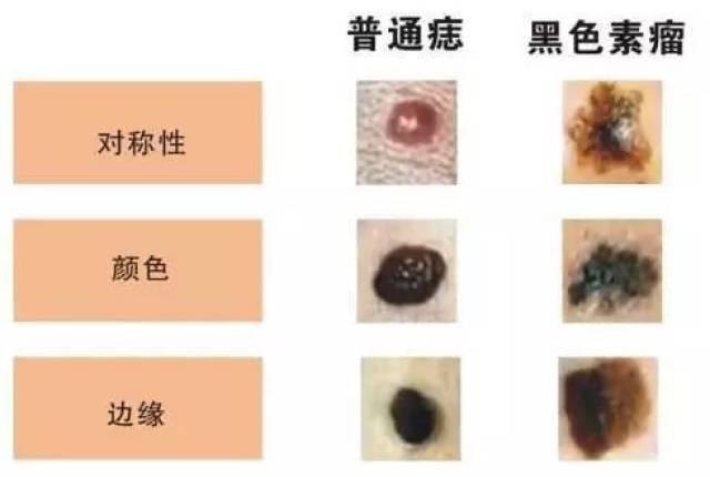 怎么区分普通黑痣与恶变黑痣  关键时刻能救命