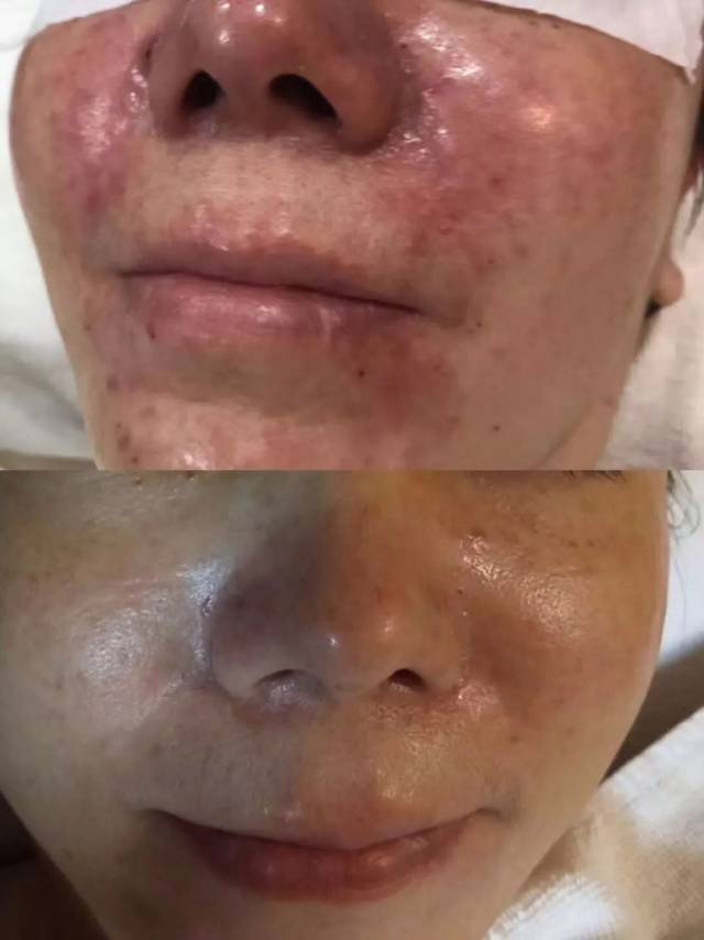 比如 有些人每到季节转换就会出现比较严重的皮肤过敏问题:发干,瘙痒