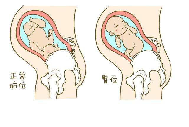 臀位分娩对胎儿危险性较大,易发生脐带脱垂,胎臂上举,后出头困难等