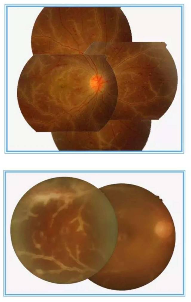 霜枝样视网膜血管炎,炎性渗出包绕血管壁,犹如冬季树枝挂霜.