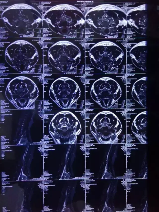 影像學診斷:頸椎反曲;頸4/5,5/6,6/7椎間盤變性伴突出;頸3/4椎間盤