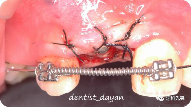 【病例】上前牙区多生牙拔除后 埋伏牙正畸牵引