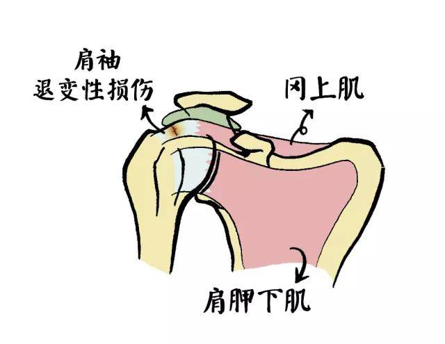 骨科醫生說事兒:肩膀痛,抬不動,肩袖損傷是元兇,肩周炎不能老背鍋(上)