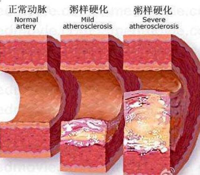 【健康管理】血脂代谢异常——血液内潜伏的危险