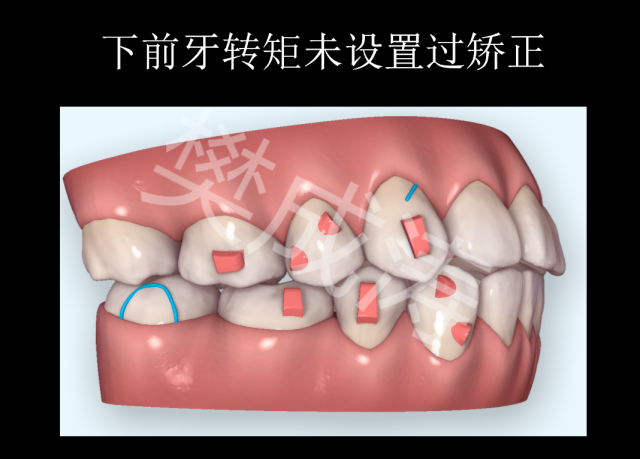 樊成涛医生:拔下颌前磨牙推上颌磨牙向远中隐形矫正