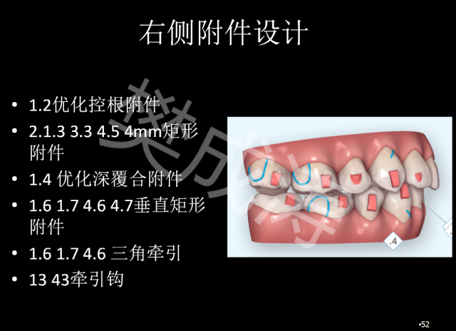 樊成涛医生:拔下颌前磨牙推上颌磨牙向远中隐形矫正