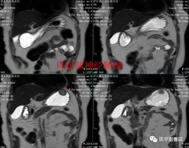 胃部肿瘤分期,请你赏析丨读片专栏685期