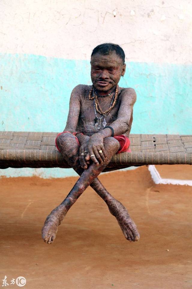 35岁的 " 蛇人 " 被称为 " 蛇人 " , 叫做