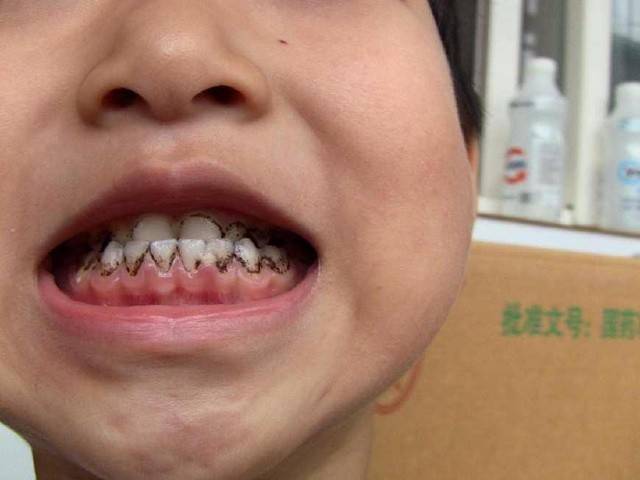 如今,越来越多的小孩都有这些情况:小小年纪,牙齿有黑斑,严重
