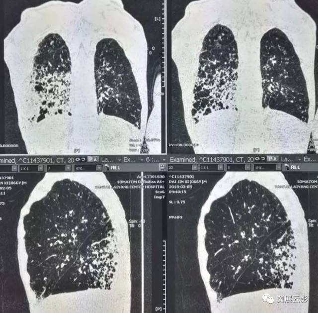 多发肺囊肿,肺结核可以表现为蜂窝状影之外,很有一种肺炎型肺癌应该